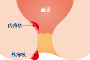 痔核（いぼ痔）