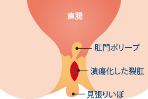 裂肛（きれ痔）