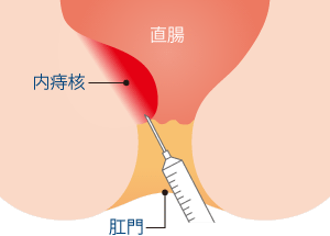 ジオンによる硬化（注射）療法〈ALTA療法〉